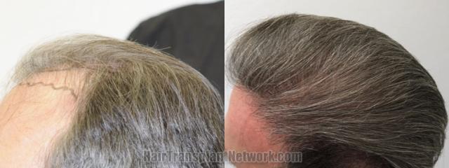 Before and after hair transplantation result photographs