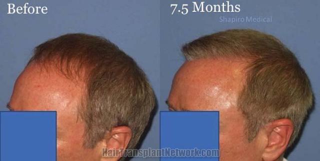 Hair transplantation surgery before and after images