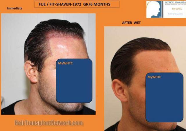 Hair transplantation surgery before and after pictures