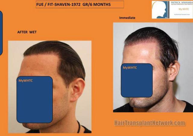 Hair restoration procedure before and after pictures