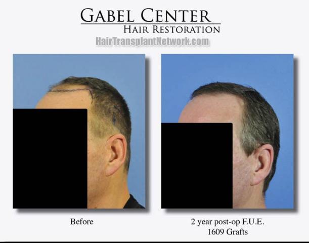 Hair restoration procedure before and after pictures