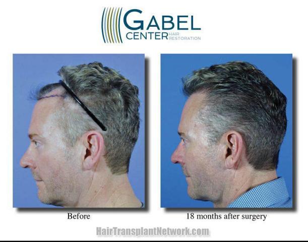 Hair restoration surgery before and after photos