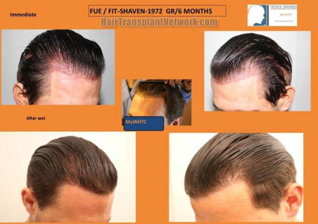 Hair transplantation surgery before and after images