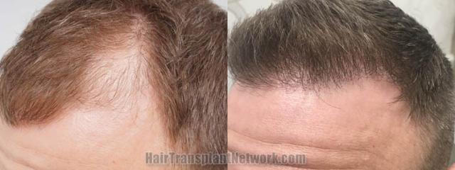 Hair restoration procedure before and after pictures