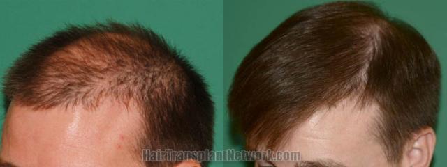 Hair restoration procedure before and after pictures