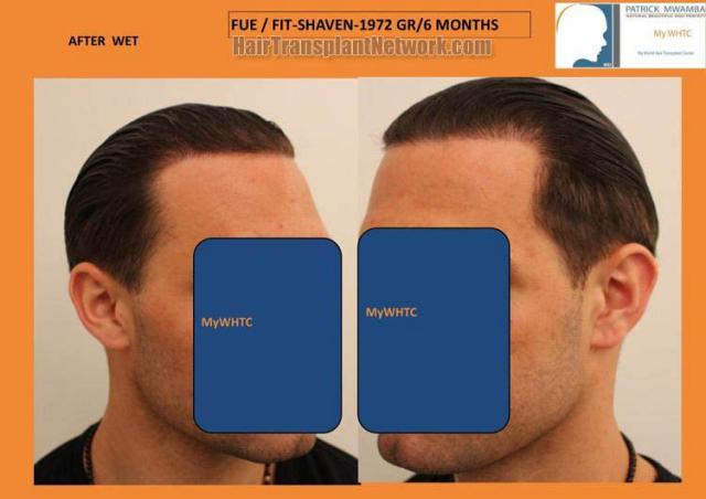 Hair transplantation surgery before and after photos