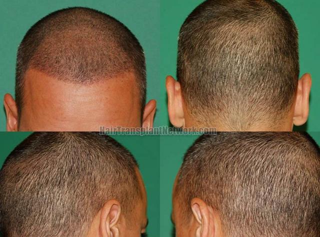 Surgical hair transplantation result photographs