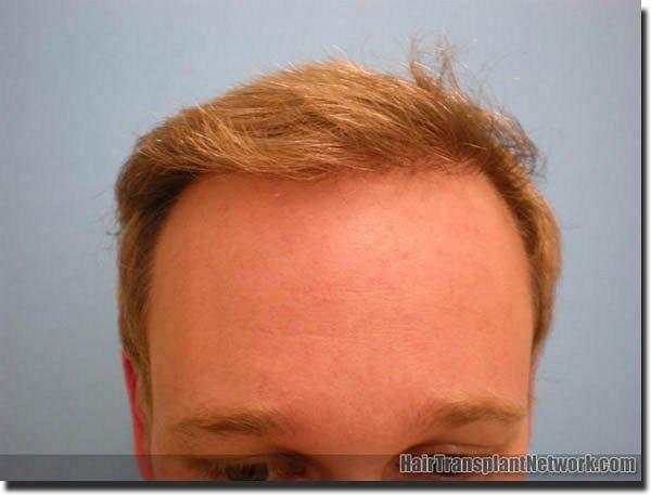 Hair restoration procedure results