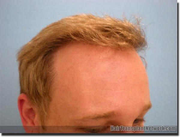 Hair restoration procedure results