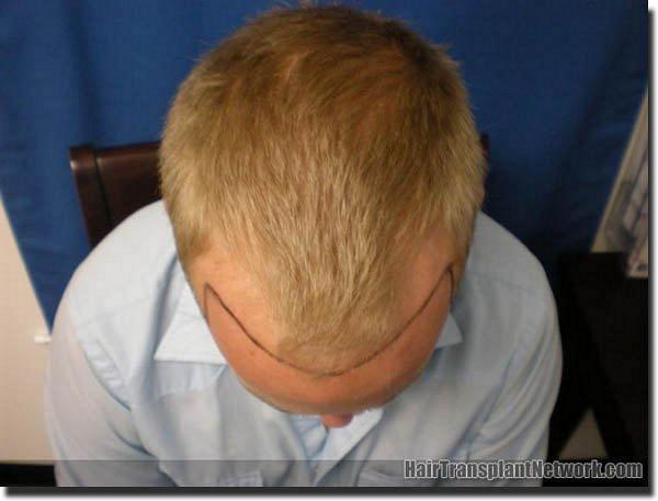 Hair restoration procedure results