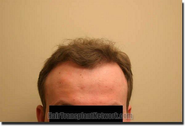 Hair restoration procedure results