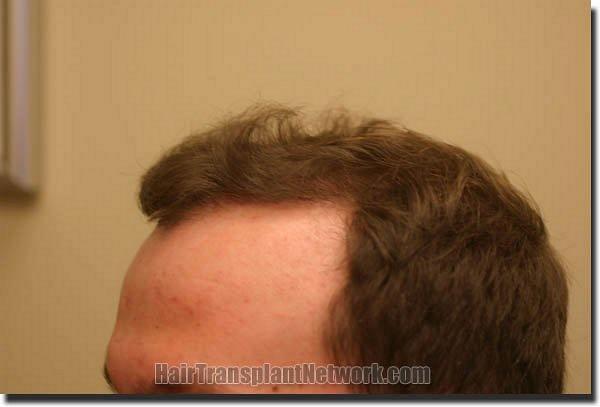 Hair restoration procedure results