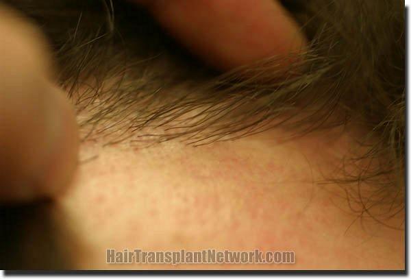 Hair restoration procedure results