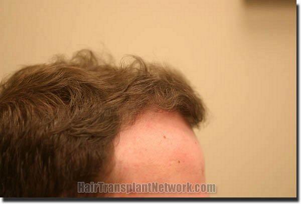 Hair restoration procedure results