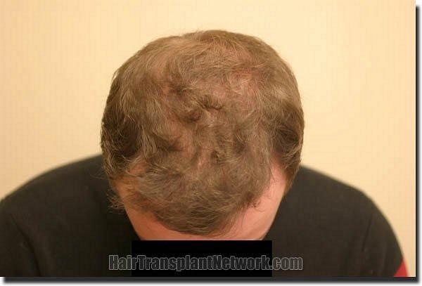 Hair restoration procedure results