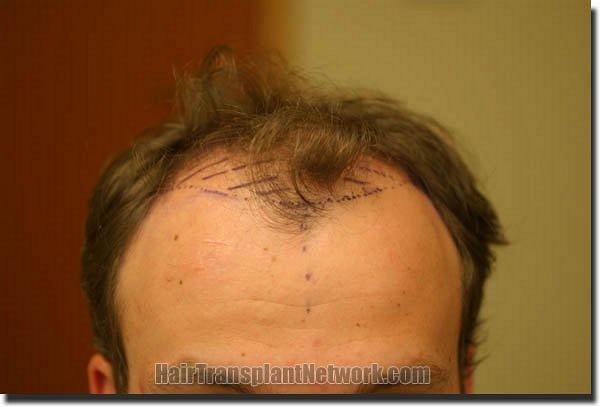 Hair restoration procedure results