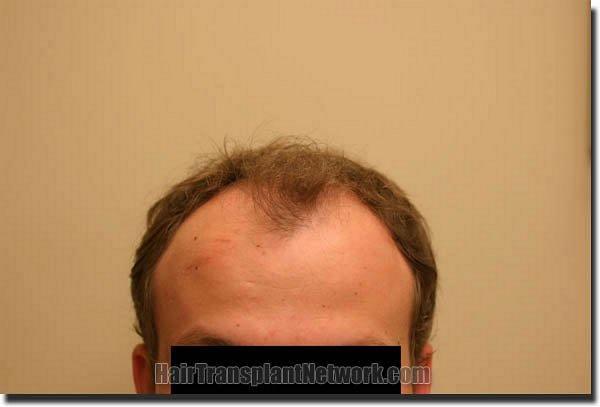 Hair restoration procedure results