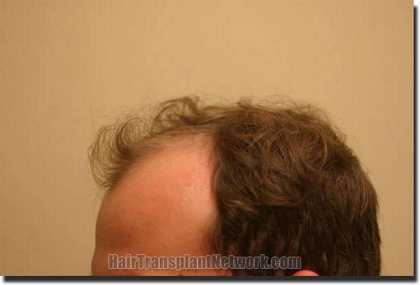 Hair restoration procedure results