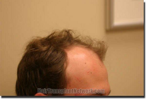 Hair restoration procedure results