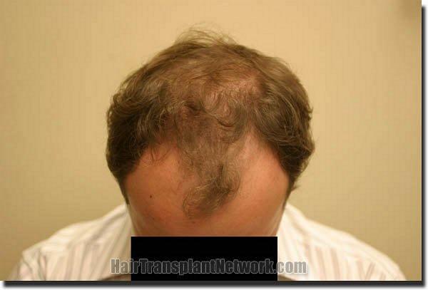 Hair restoration procedure results