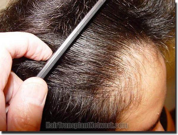 Hair restoration procedure results