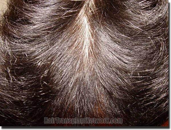 Hair restoration procedure results