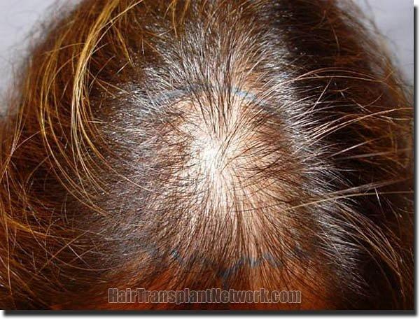 Hair restoration procedure results