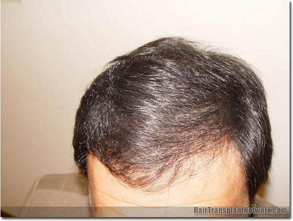 Hair restoration procedure results