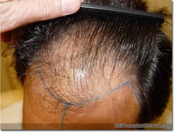 Hair restoration procedure results