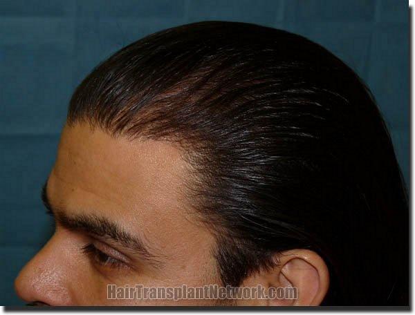 Hair restoration procedure results