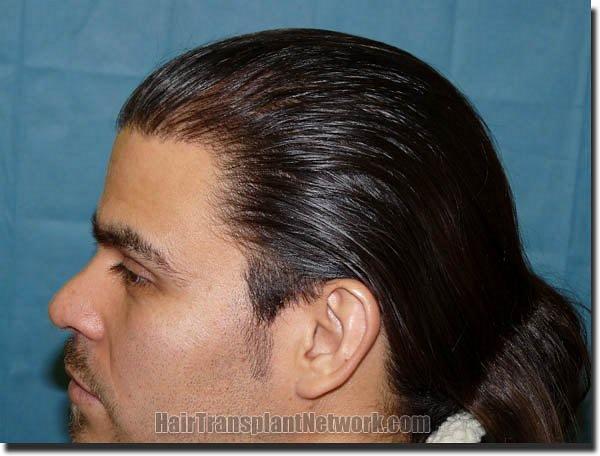 Hair restoration procedure results