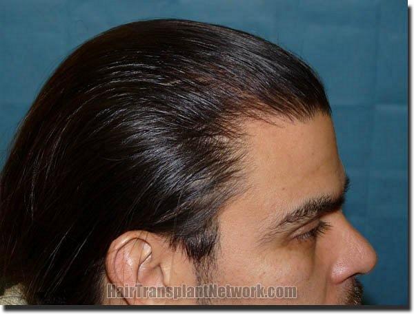 Hair restoration procedure results