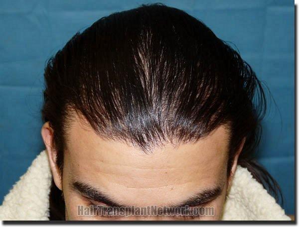 Hair restoration procedure results