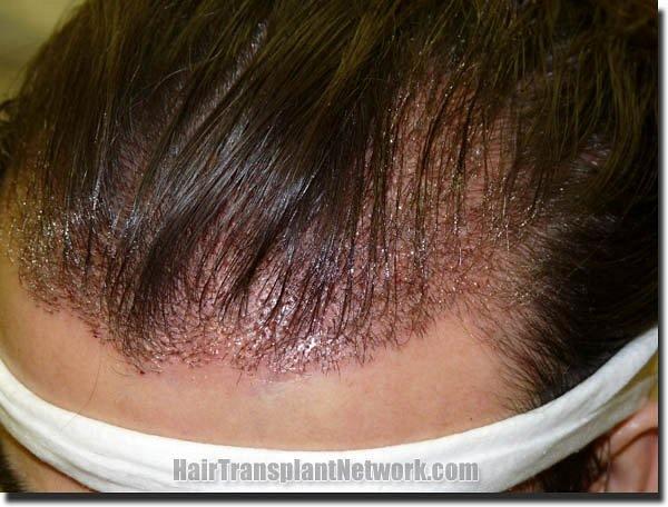 Hair restoration procedure results