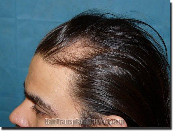 Hair restoration procedure results