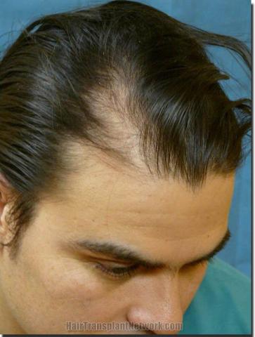 Hair restoration procedure results