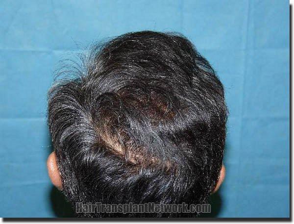 Hair restoration procedure results