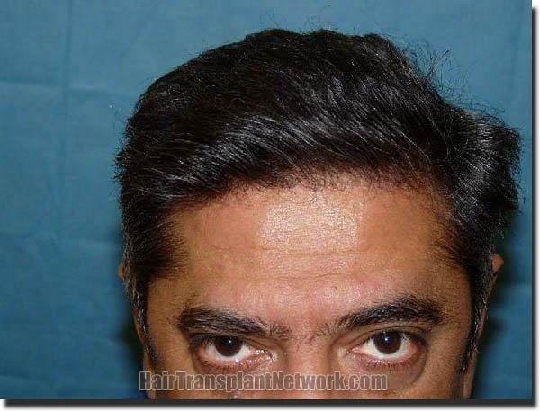 Hair restoration procedure results