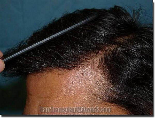 Hair restoration procedure results