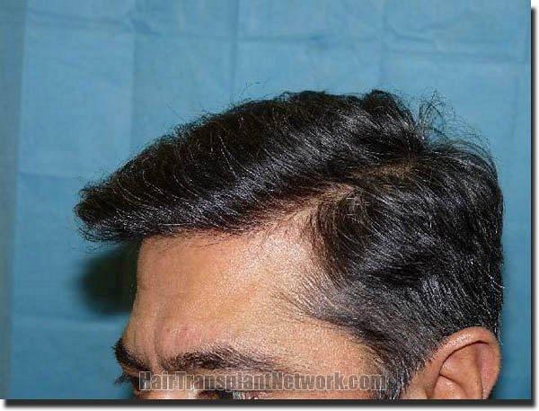 Hair restoration procedure results