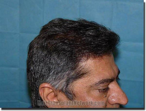 Hair restoration procedure results