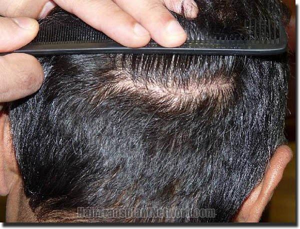 Hair restoration procedure results