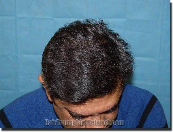 Hair restoration procedure results