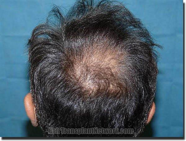 Hair restoration procedure results