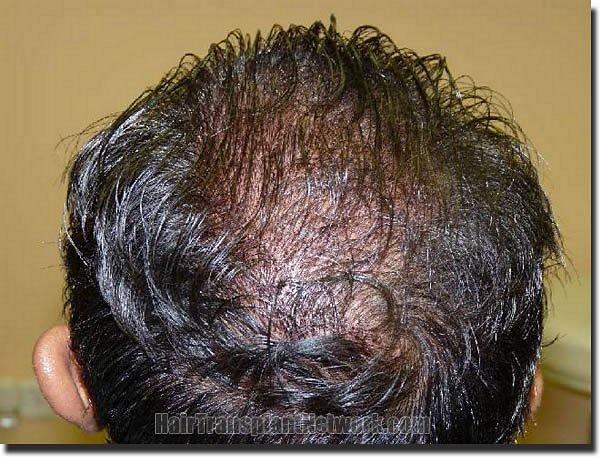 Hair restoration procedure results