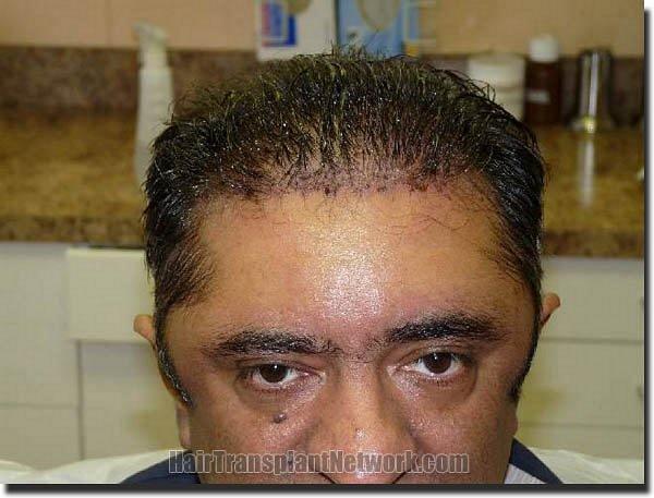 Hair restoration procedure results