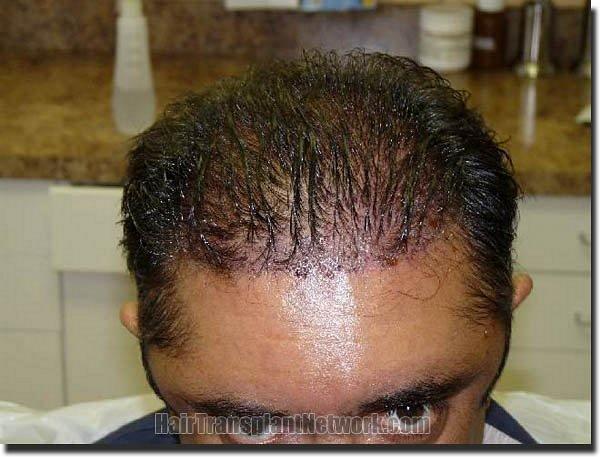 Hair restoration procedure results