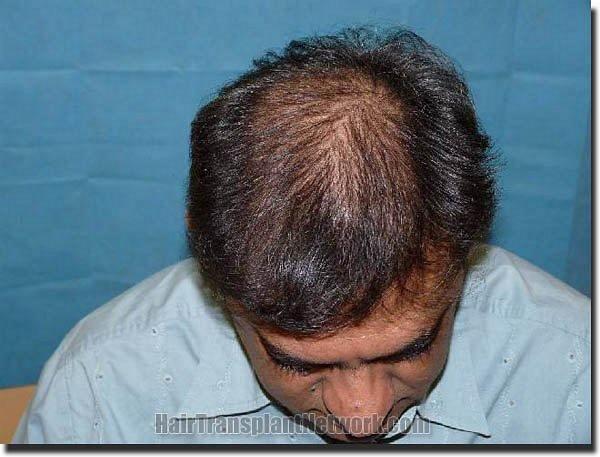 Hair restoration procedure results