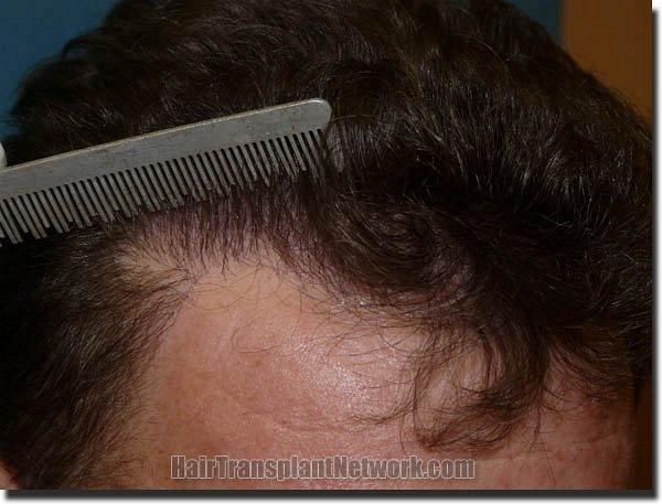 Hair restoration procedure results