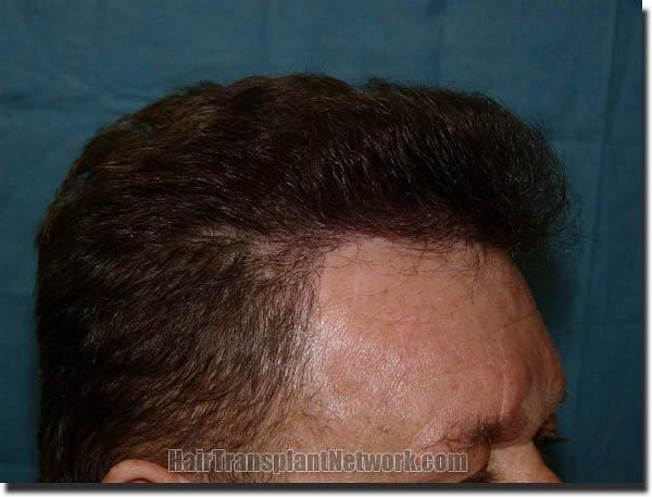 Hair restoration procedure results